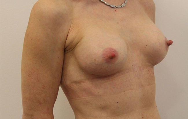 Brustvergrößerung Linz Vorher Nachher Bilder